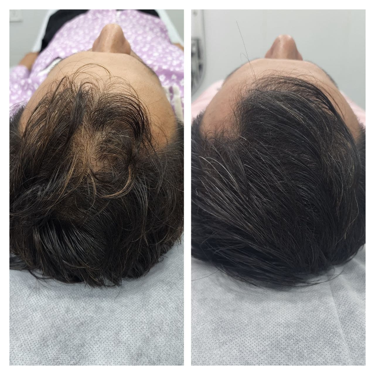 Pigmentation treatment