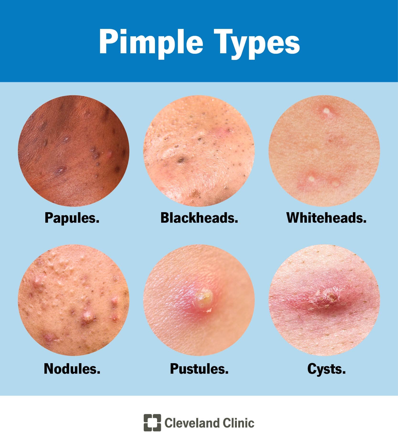 What is the Difference Between Pimple and Acne?